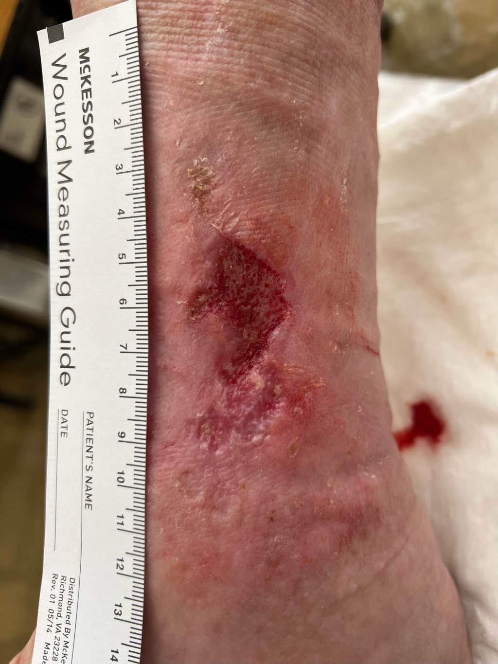 softkcot case1 after